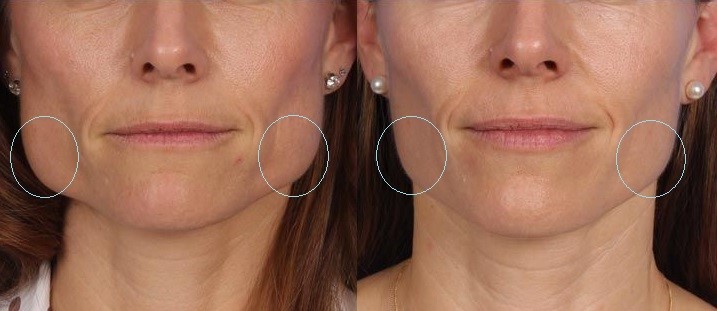 Photo showing Botox before and after