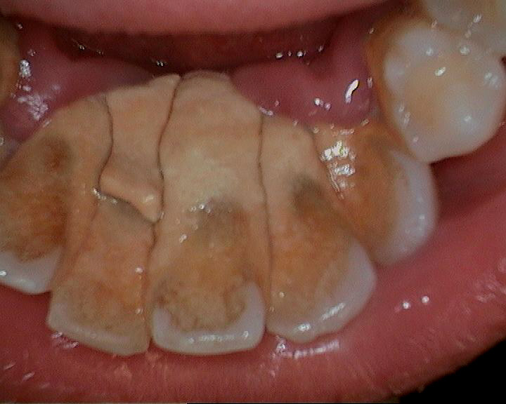 Image showing stains on the back of teeth