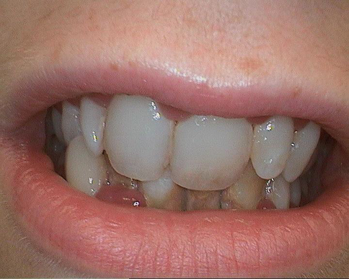 Infected teeth