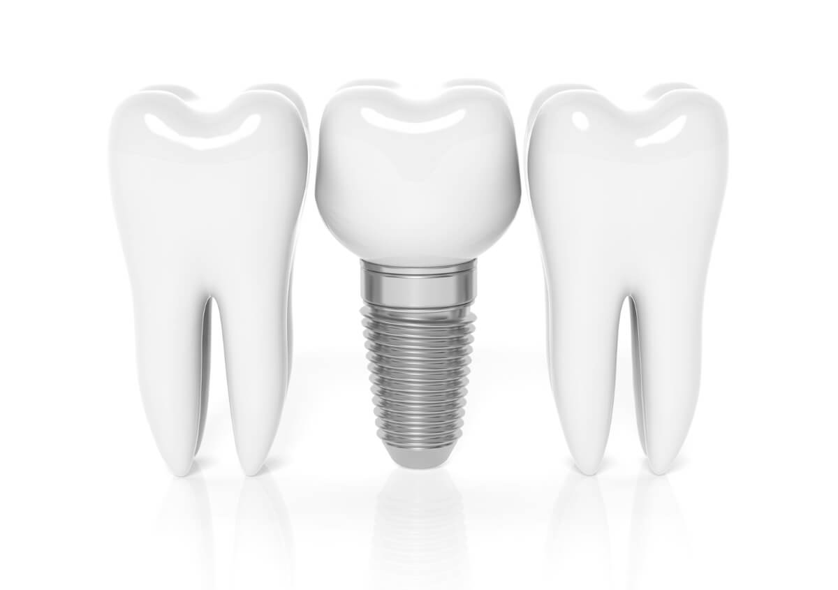 Best Dental Implant Dentist in Fort Worth TX area