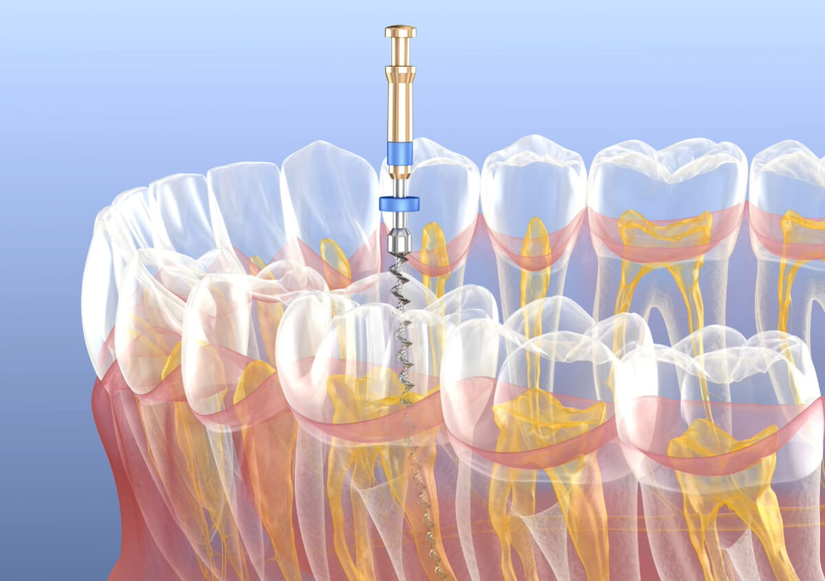 Dentist that do Root Canals in Fort Worth TX area